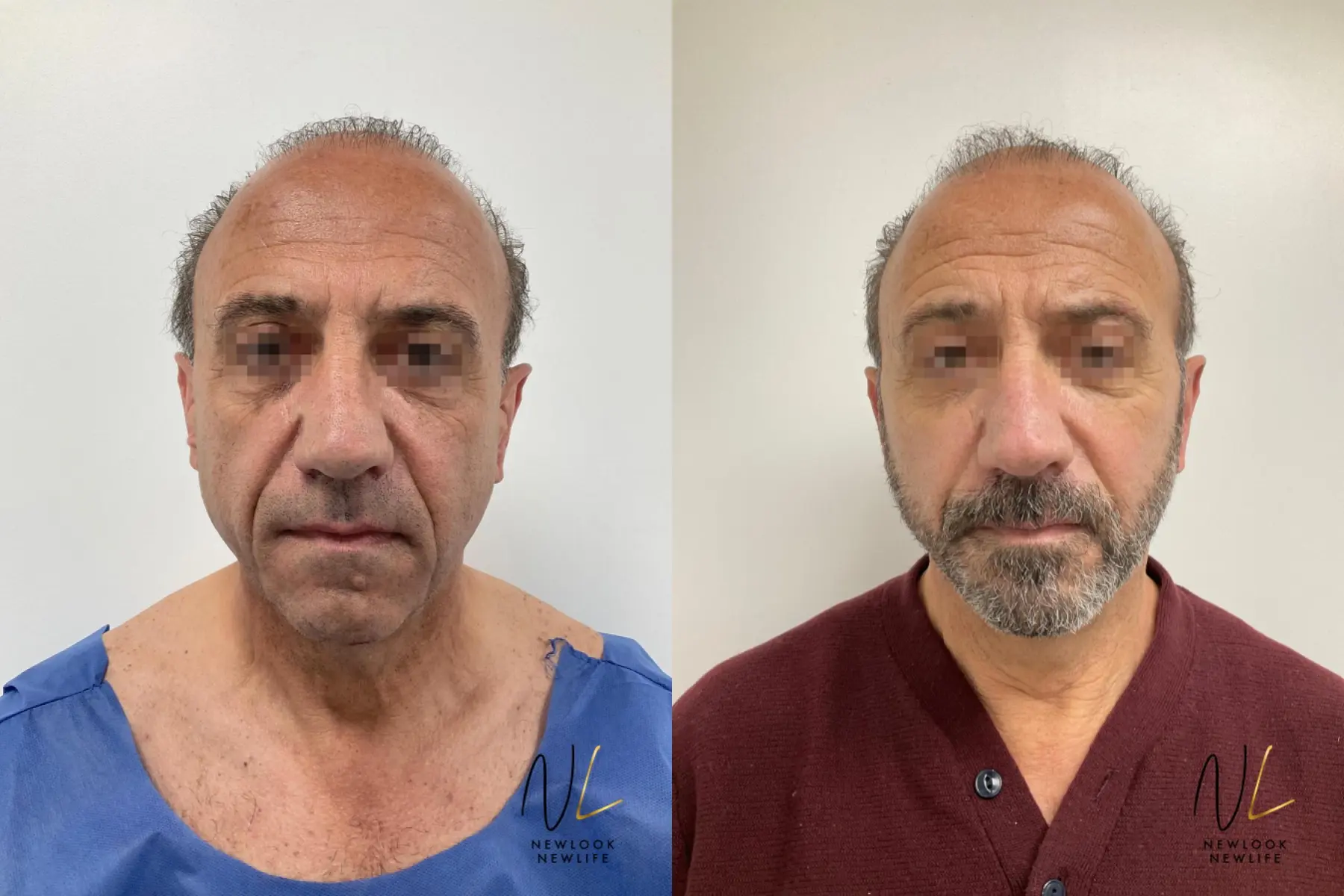 Facelift: Patient 2 - Before and After 1