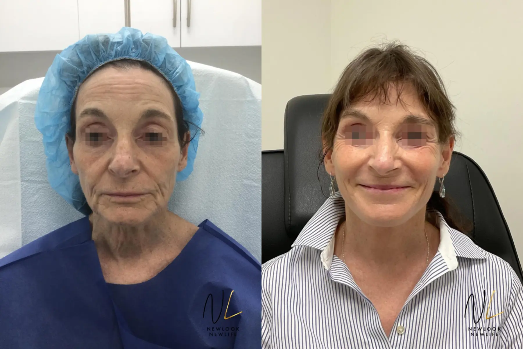 Facelift: Patient 1 - Before and After  