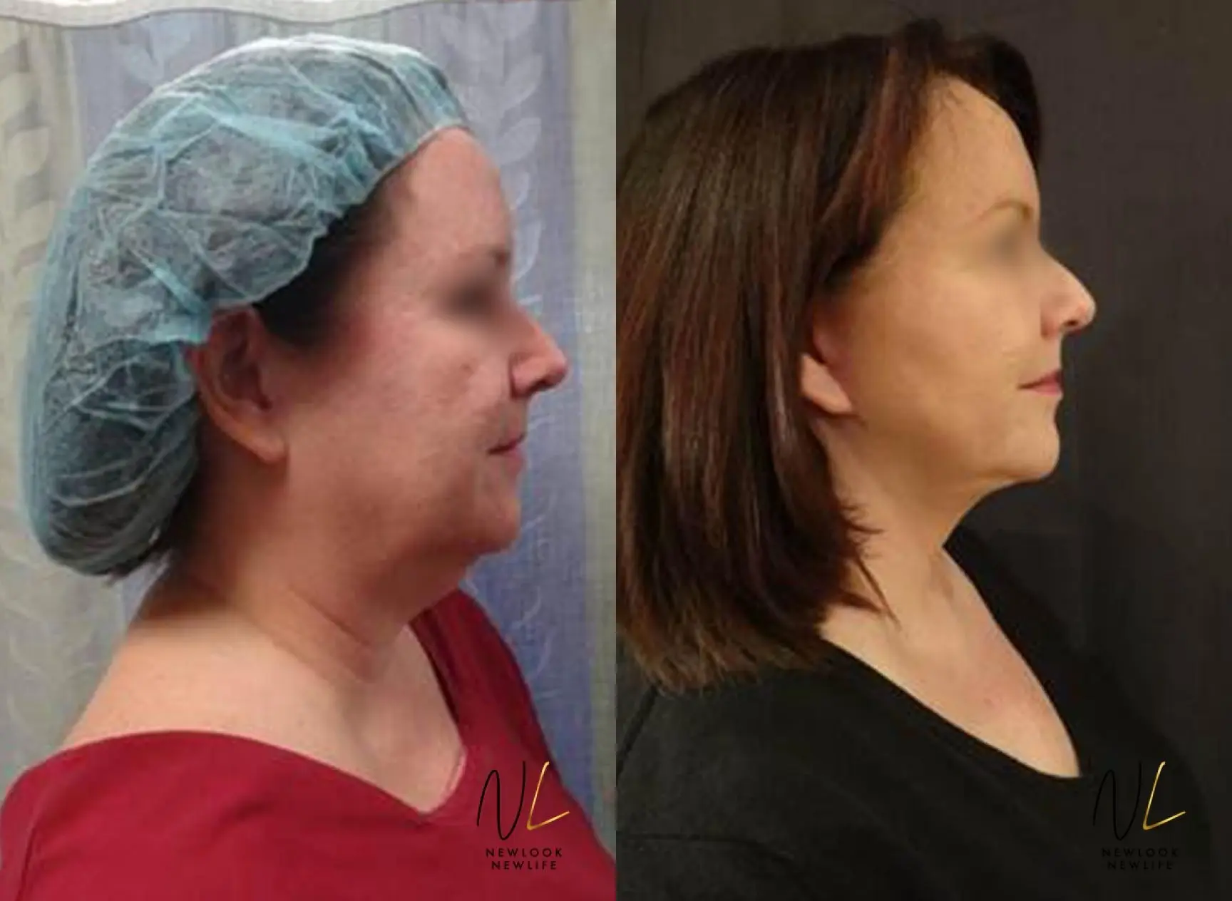 Facelift: Patient 6 - Before and After 1