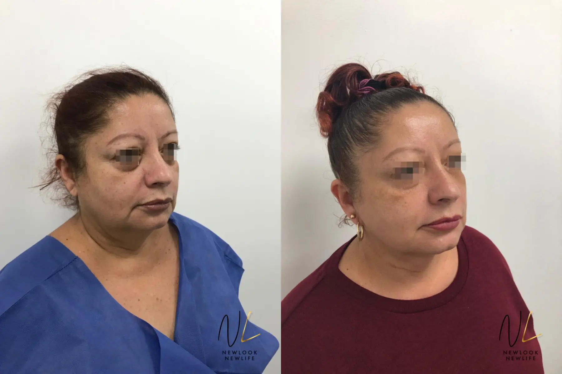 Facelift: Patient 3 - Before and After  