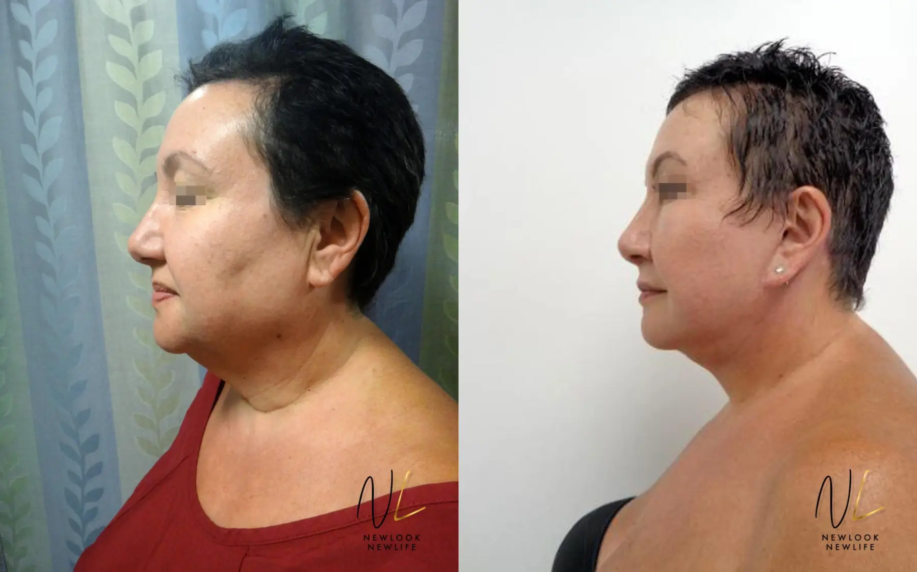 Facelift: Patient 9 - Before and After 1