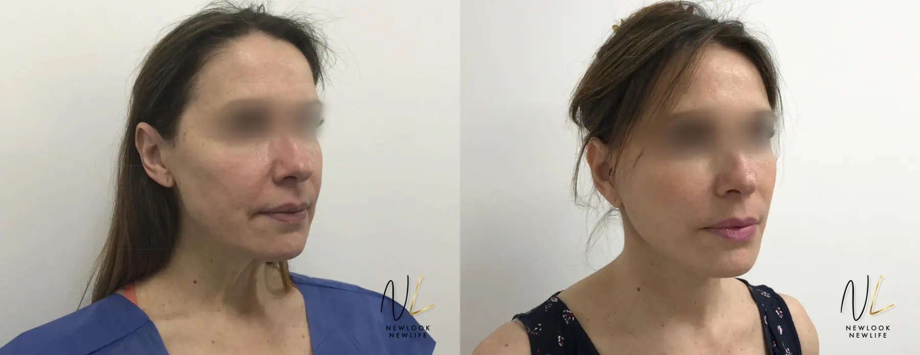 Facelift: Patient 7 - Before and After  