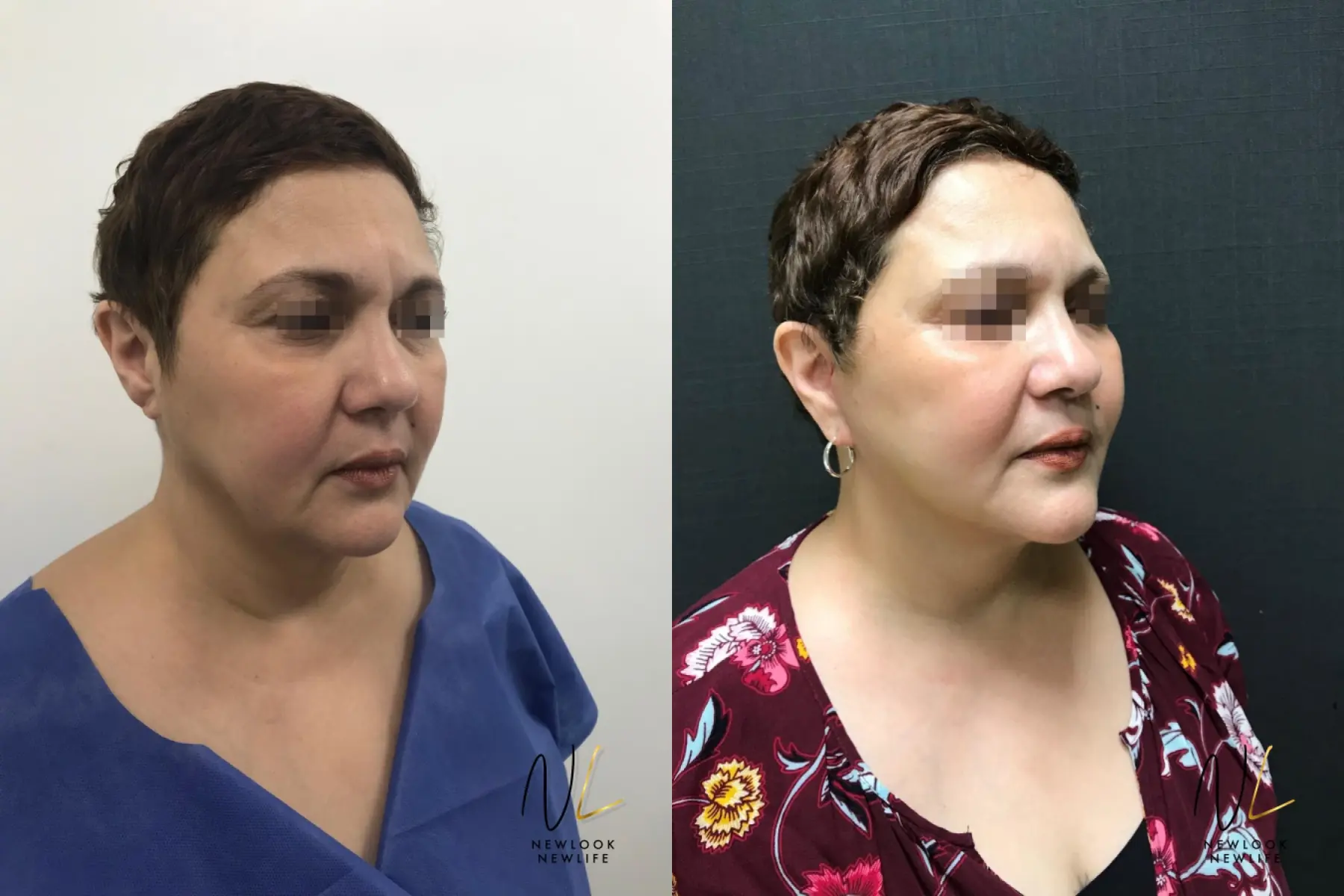 Facelift: Patient 8 - Before and After 1