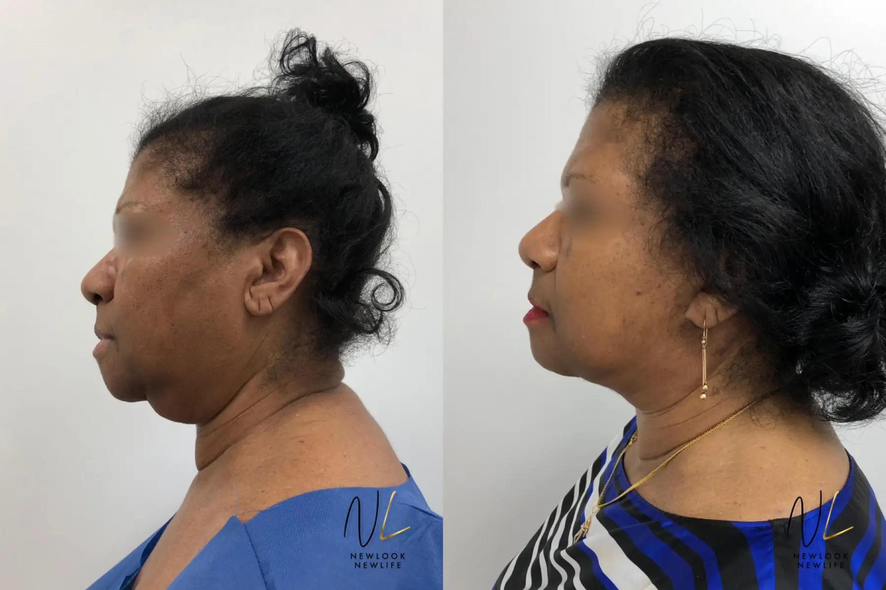 Facelift: Patient 10 - Before and After 1