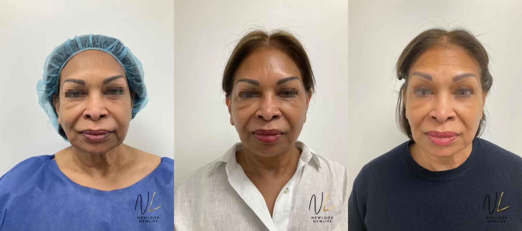 Facelift: Patient 4 - Before and After  