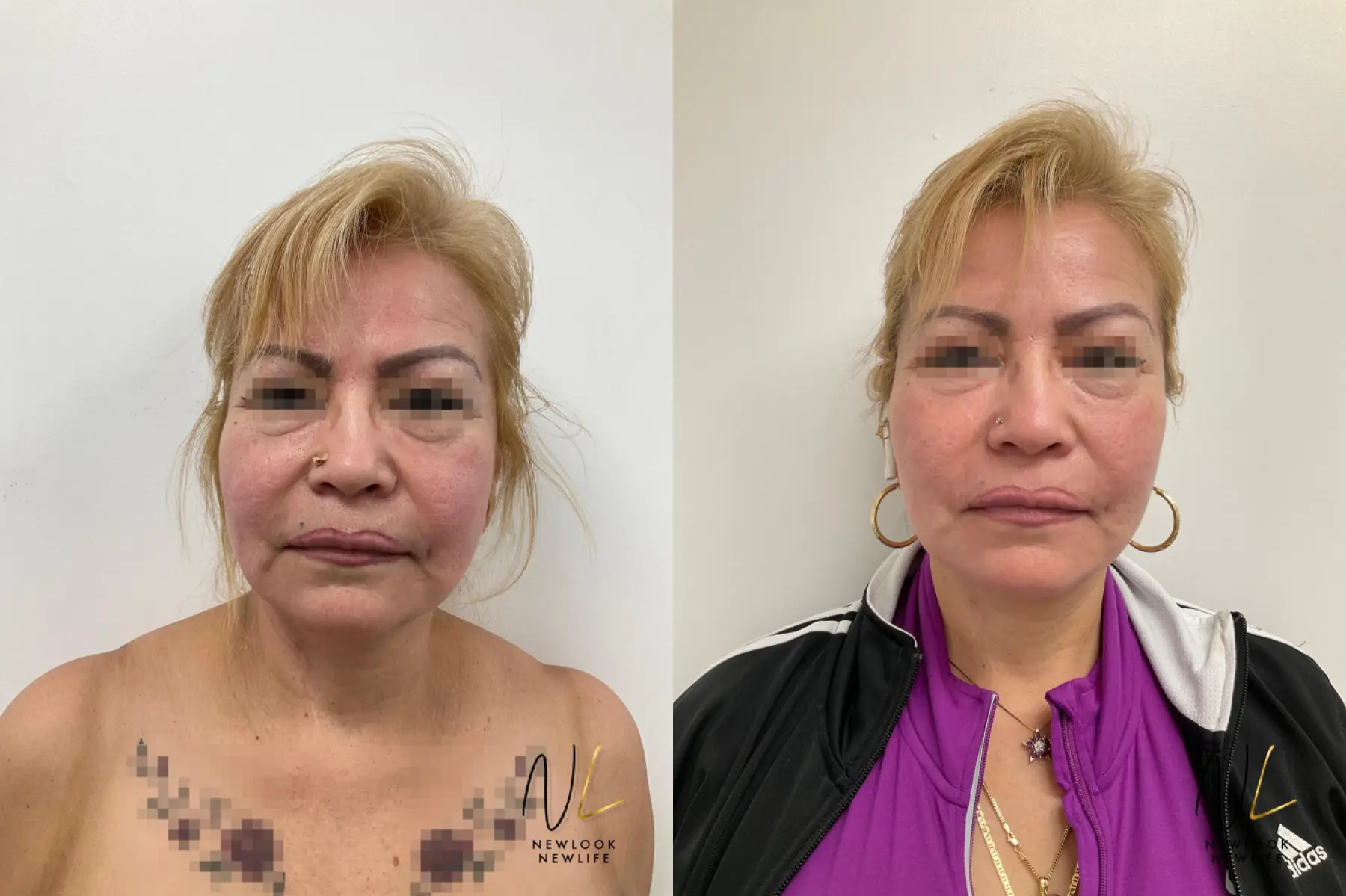 Fat Grafting: Patient 3 - Before and After  