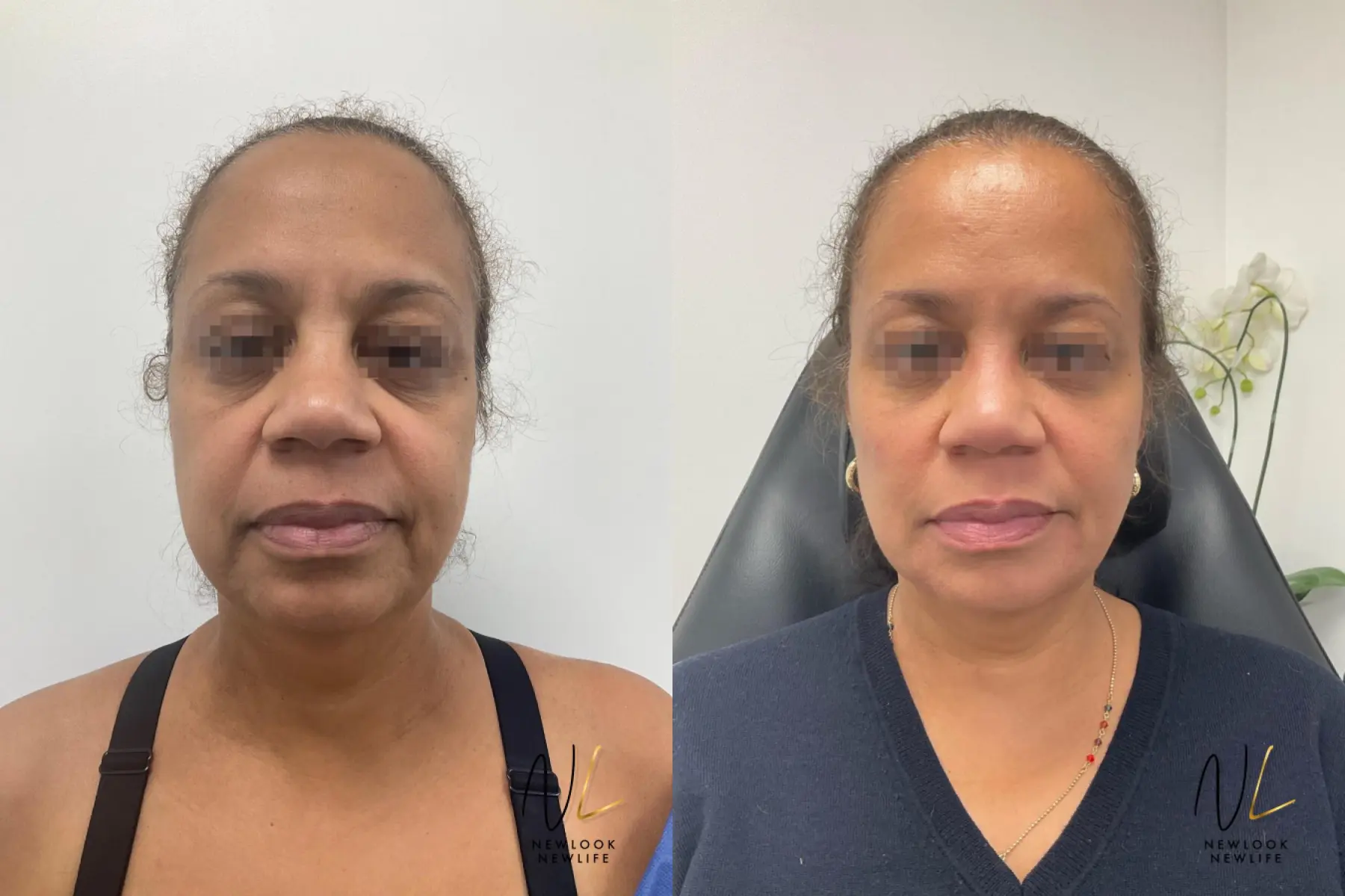 Fat Grafting: Patient 2 - Before and After 1