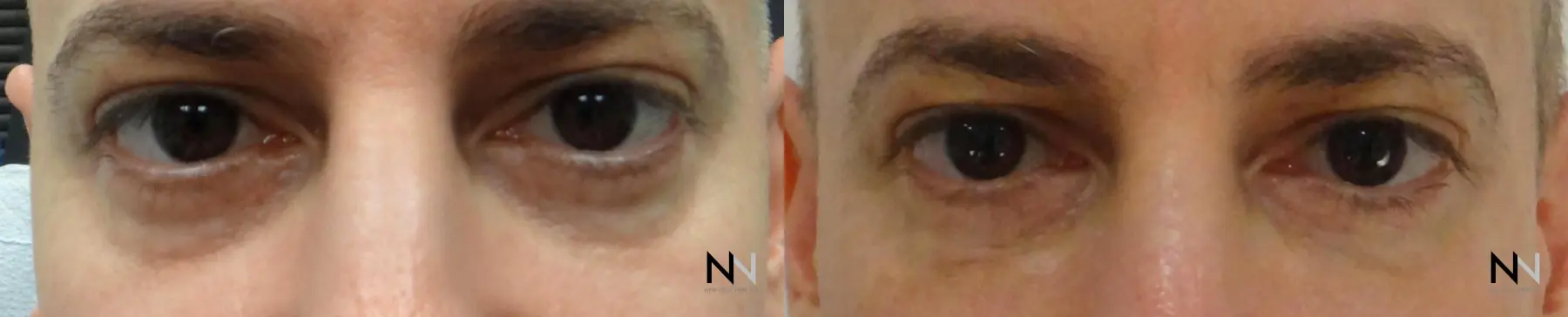 Fillers: Patient 9 - Before and After  