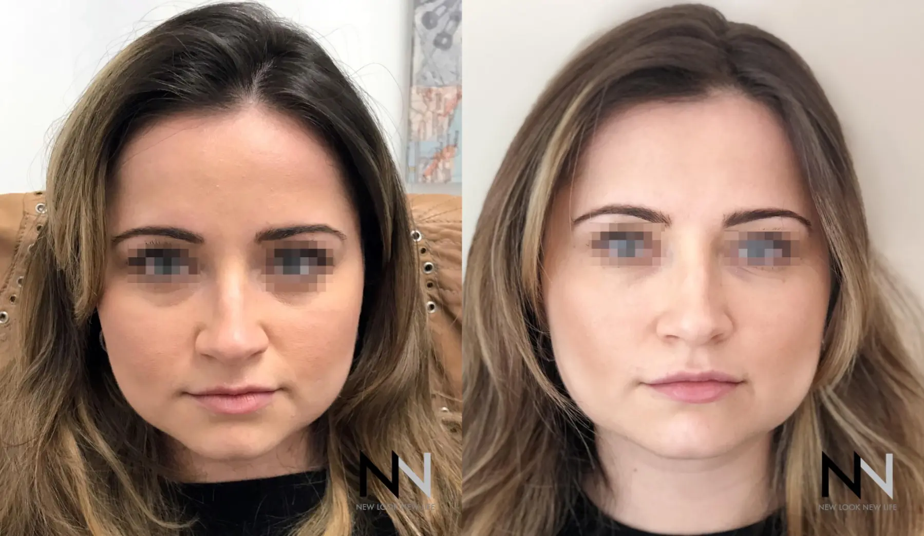 Fillers: Patient 10 - Before and After 1