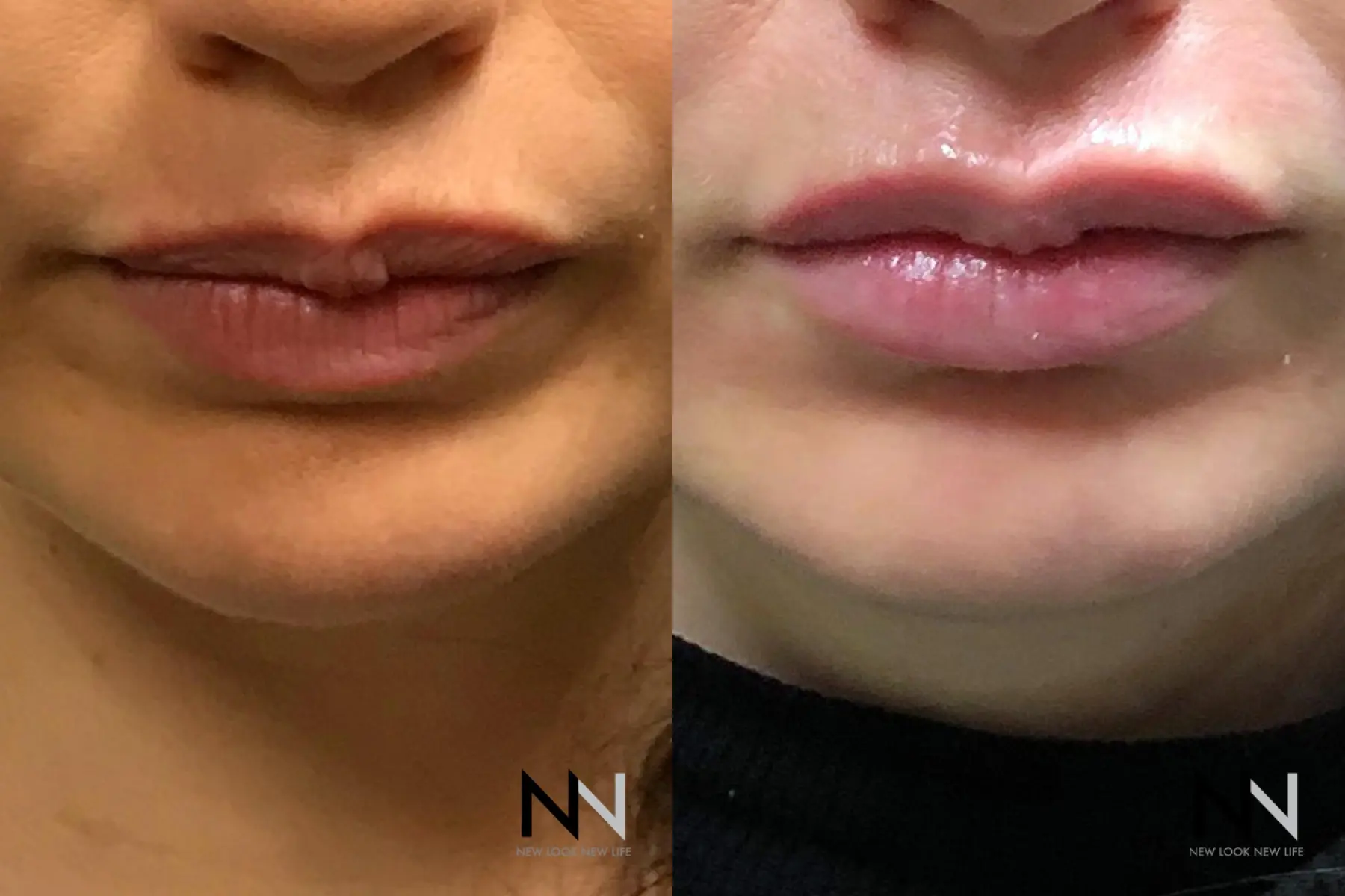 Fillers: Patient 2 - Before and After  