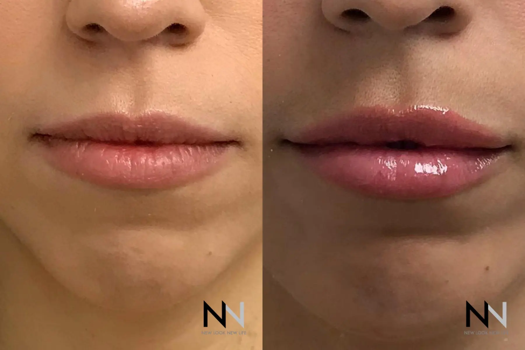 Fillers: Patient 1 - Before and After  