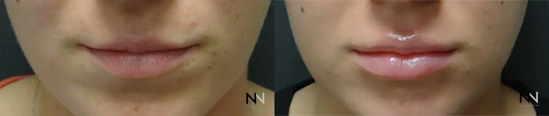 Fillers: Patient 3 - Before and After 1