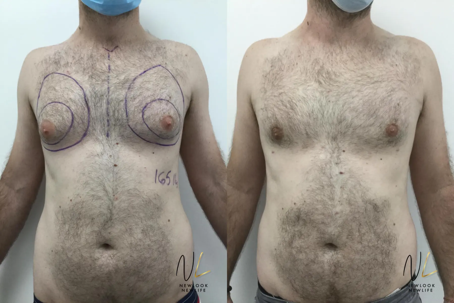 Gynecomastia: Patient 9 - Before and After  