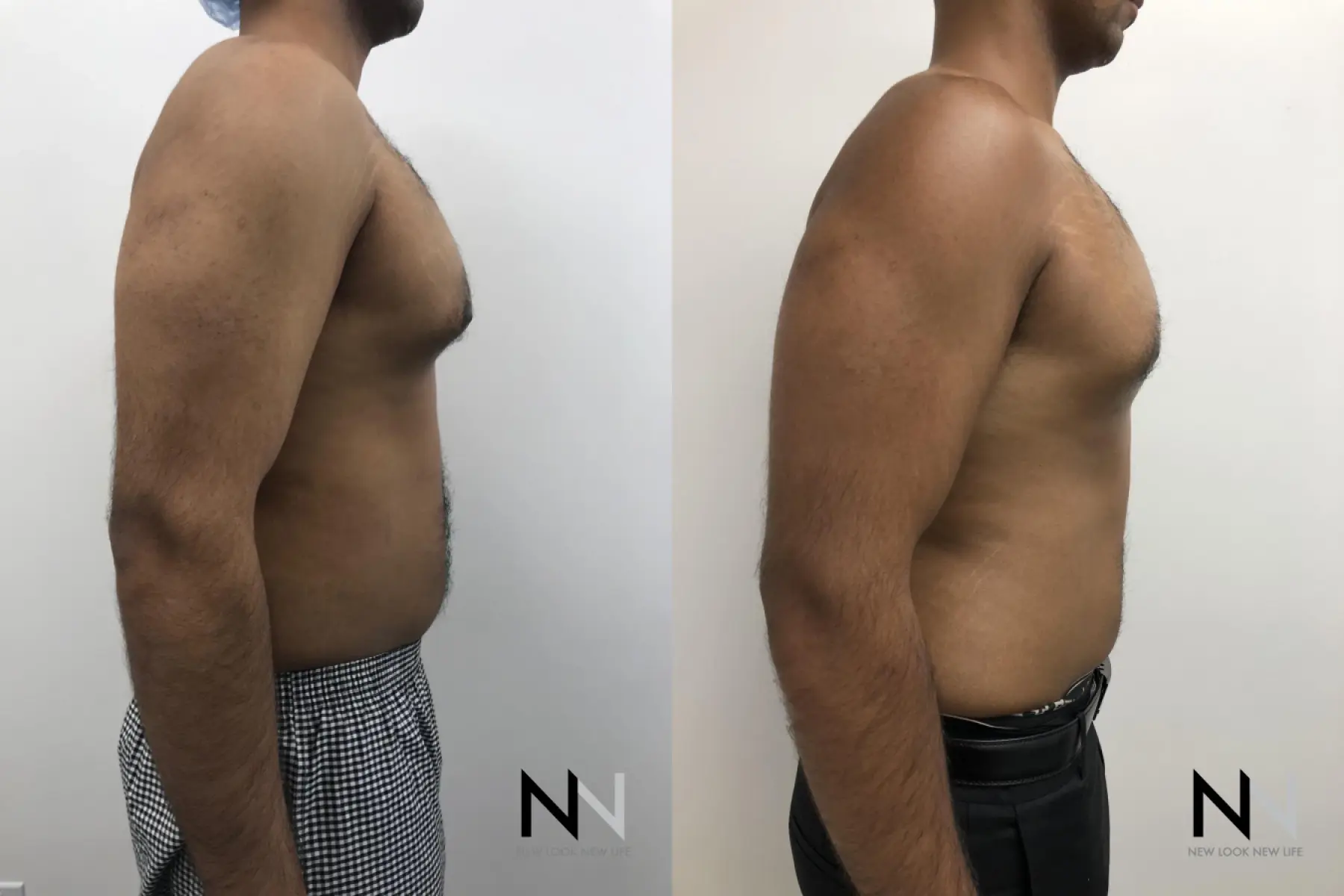 Gynecomastia: Patient 7 - Before and After 5