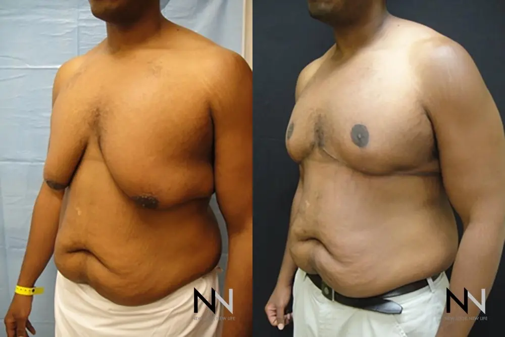 Gynecomastia: Patient 17 - Before and After 2