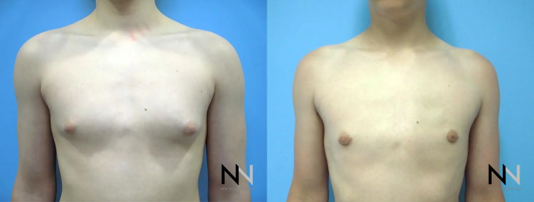 Gynecomastia: Patient 21 - Before and After 1