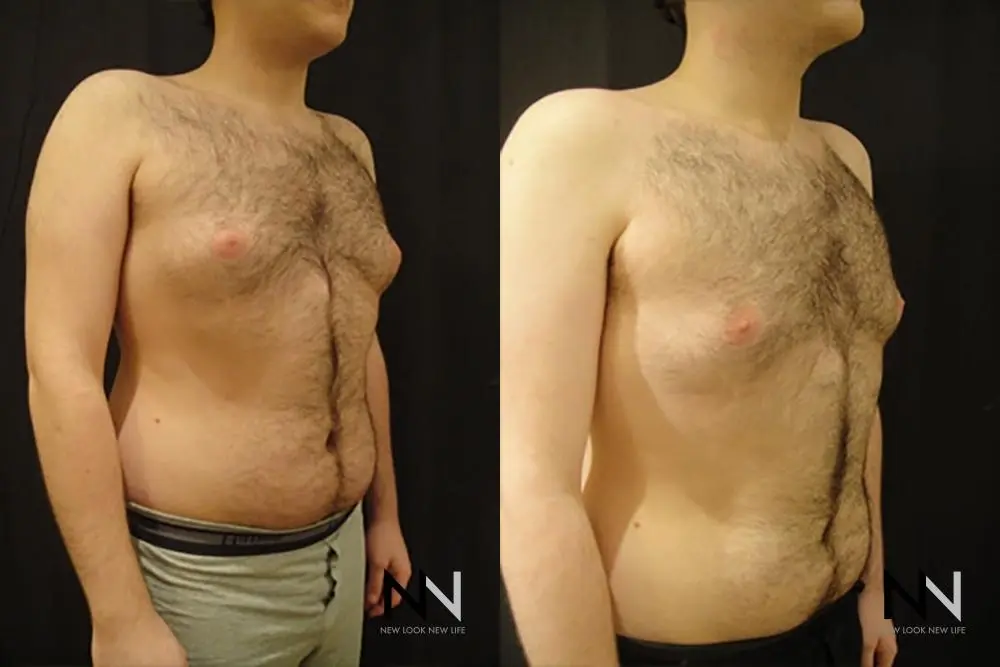 Gynecomastia: Patient 19 - Before and After 3