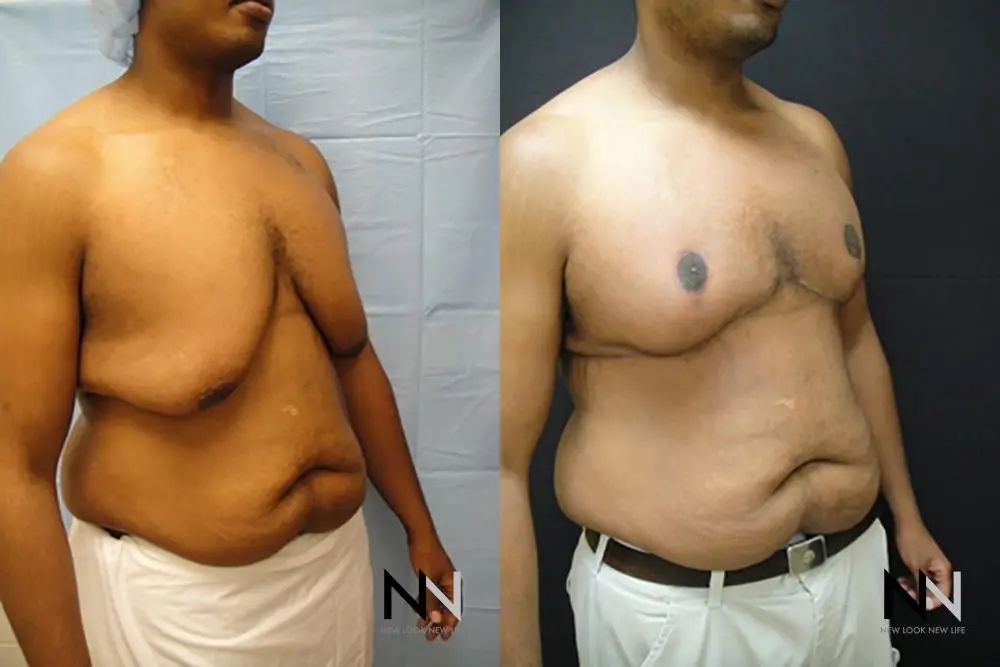 Gynecomastia: Patient 17 - Before and After 3