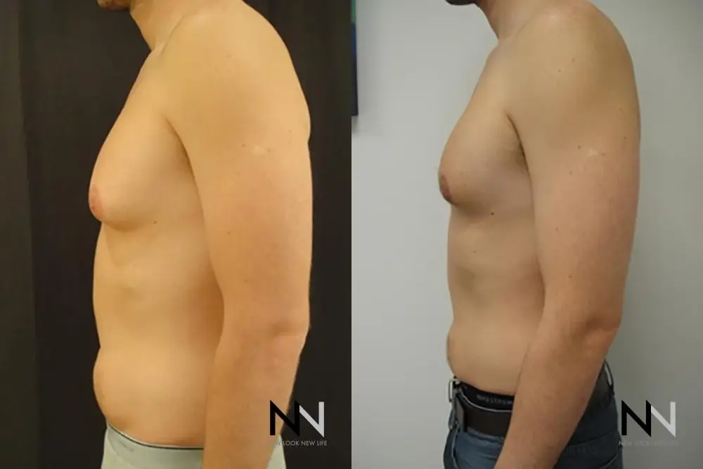 Gynecomastia: Patient 18 - Before and After 4