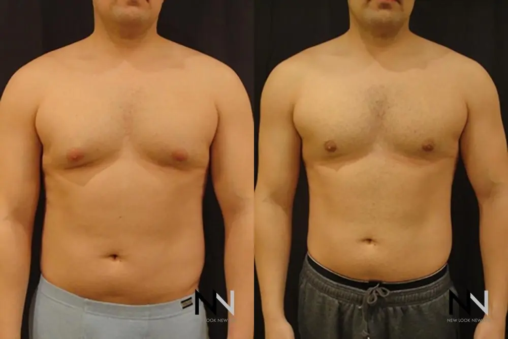 Gynecomastia: Patient 12 - Before and After 1