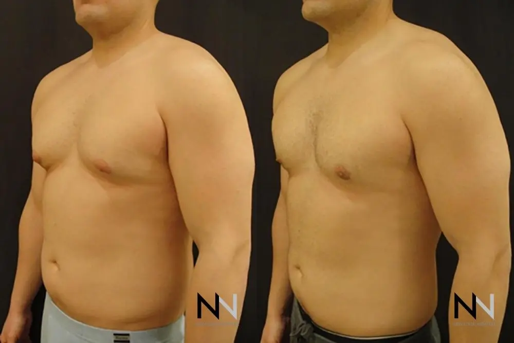 Gynecomastia: Patient 12 - Before and After 2