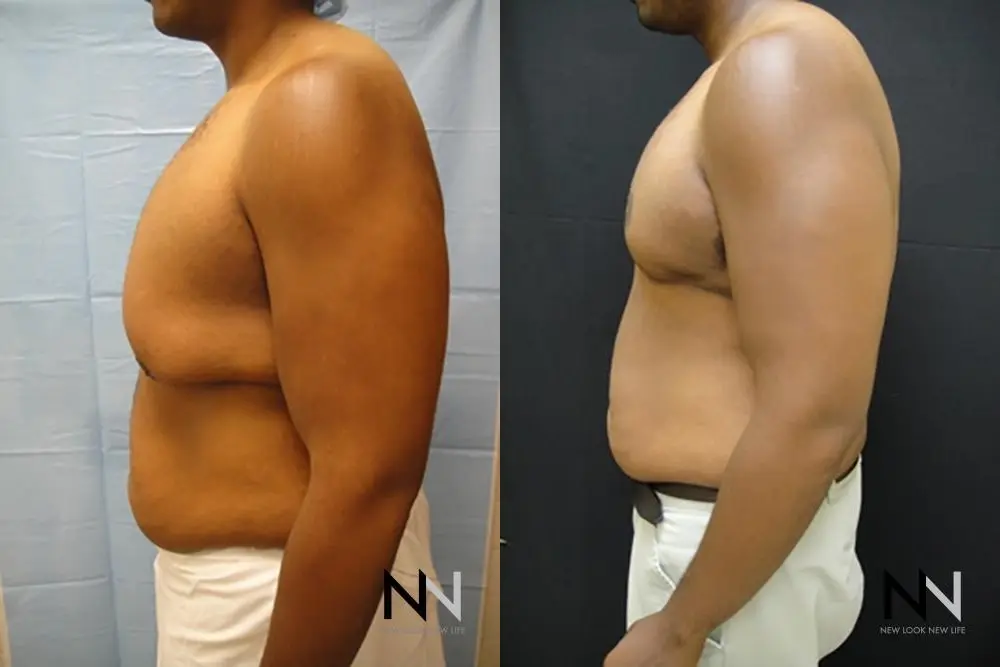 Gynecomastia: Patient 17 - Before and After 4