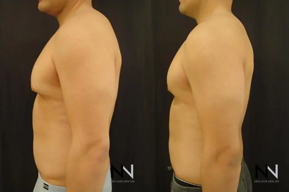 Gynecomastia: Patient 12 - Before and After 4