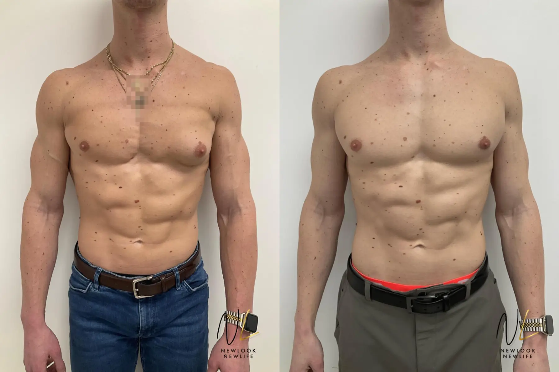 Gynecomastia: Patient 6 - Before and After  