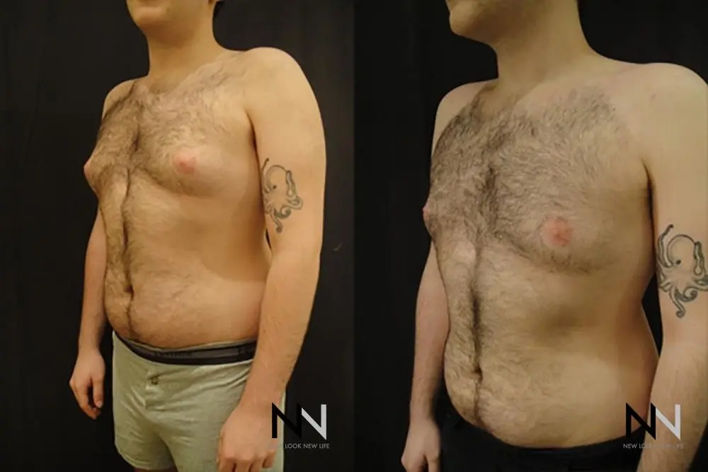 Gynecomastia: Patient 19 - Before and After 2