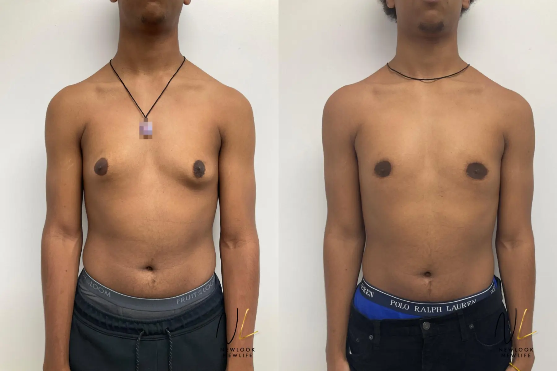 Gynecomastia: Patient 3 - Before and After  