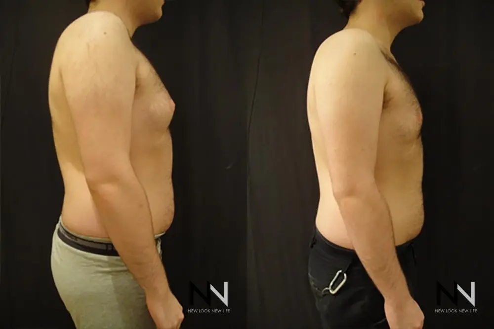 Gynecomastia: Patient 19 - Before and After 4