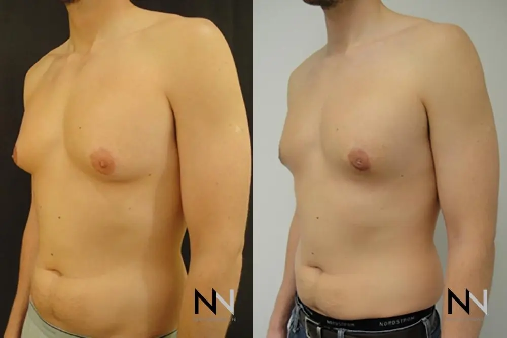 Gynecomastia: Patient 18 - Before and After 2