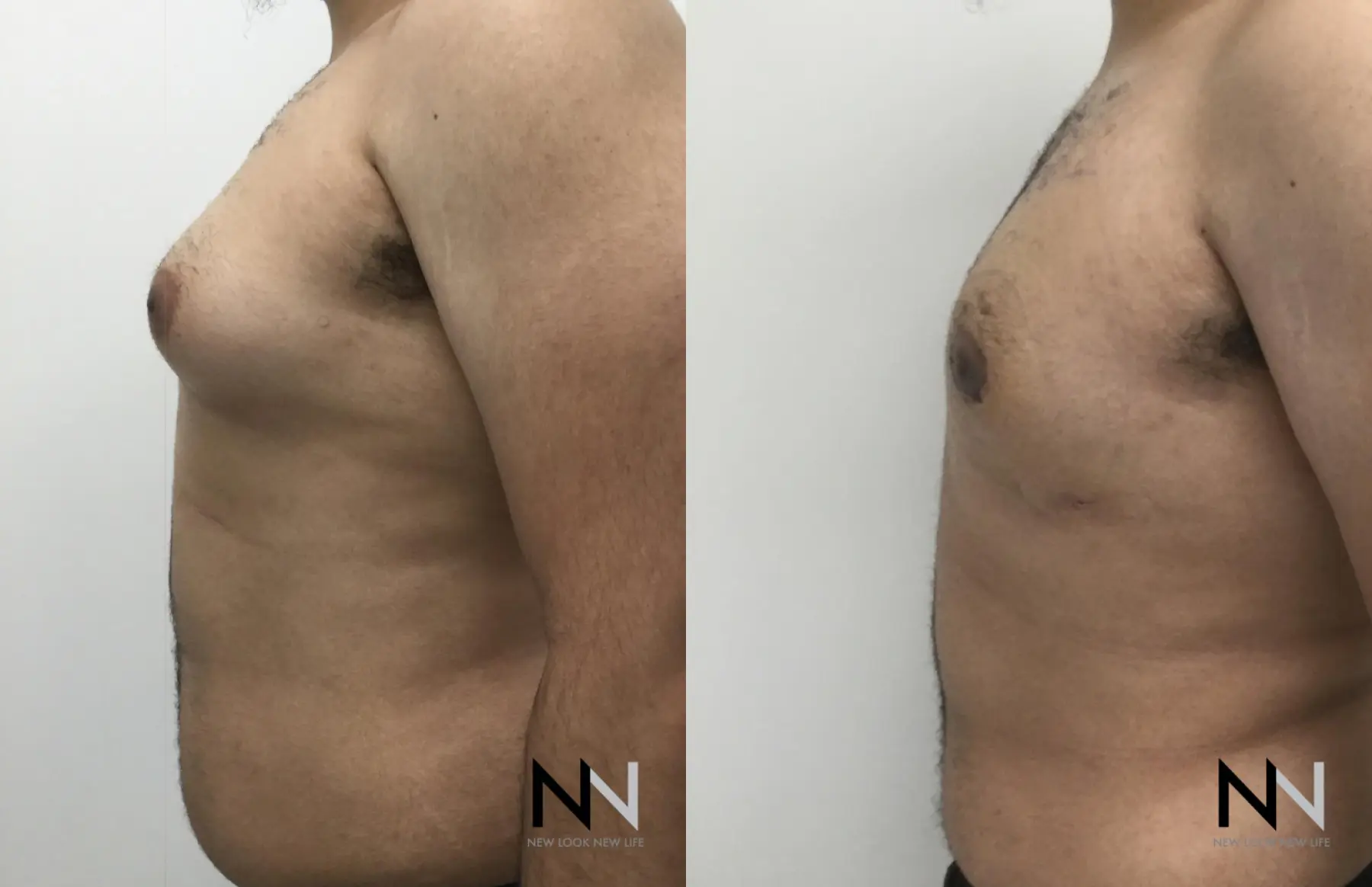 Gynecomastia: Patient 16 - Before and After 2