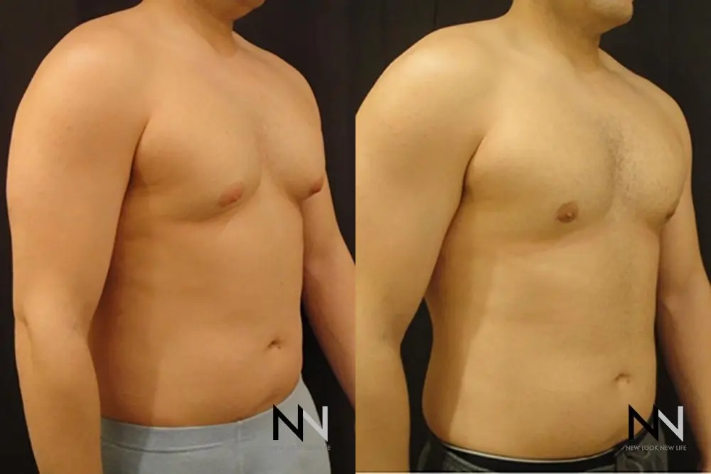 Gynecomastia: Patient 12 - Before and After 3