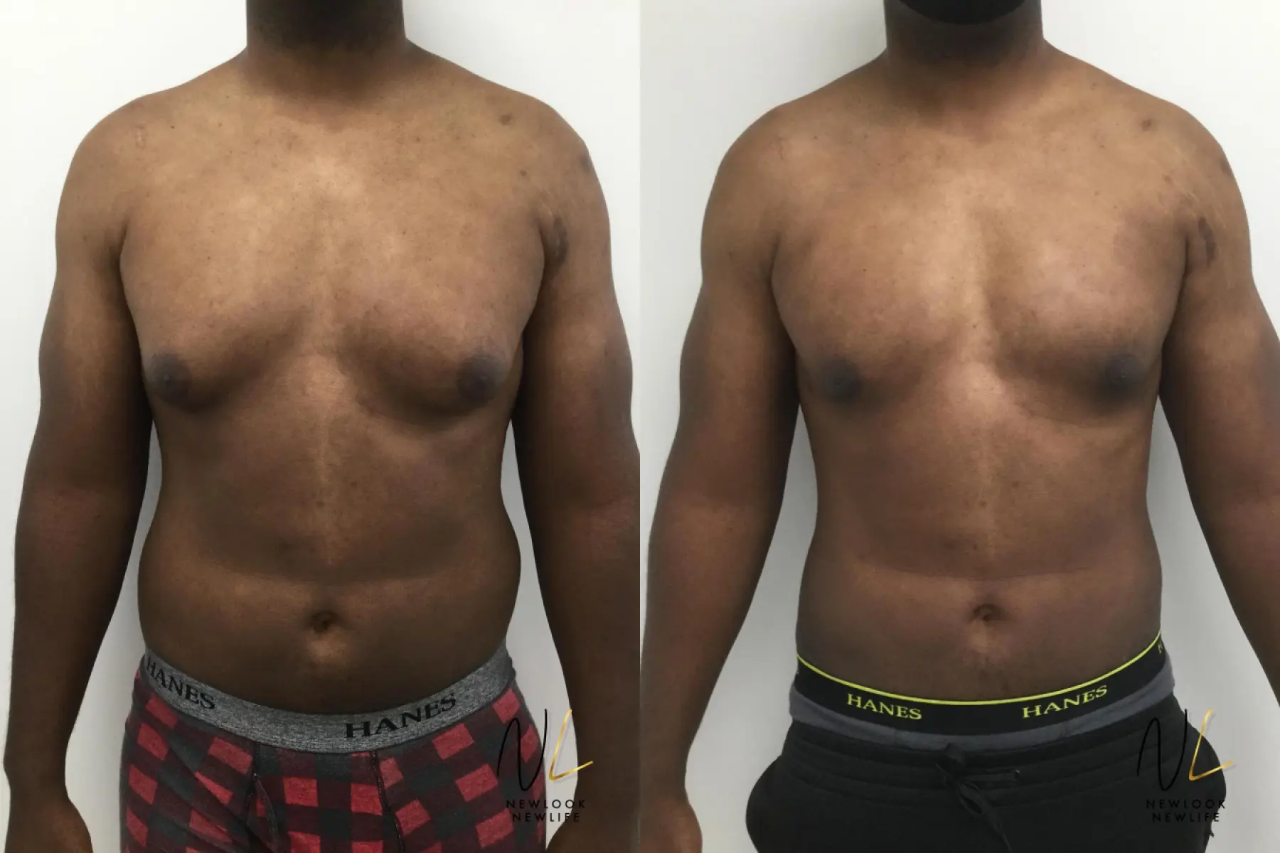 Gynecomastia: Patient 5 - Before and After  