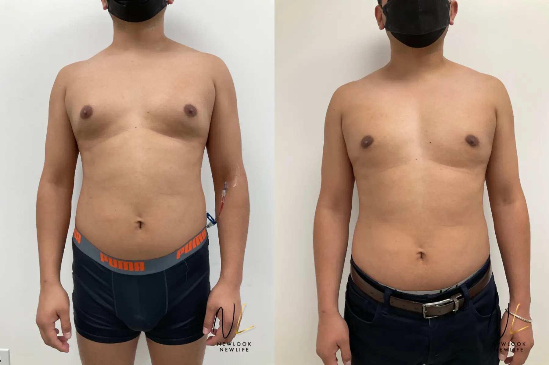 Gynecomastia: Patient 10 - Before and After  