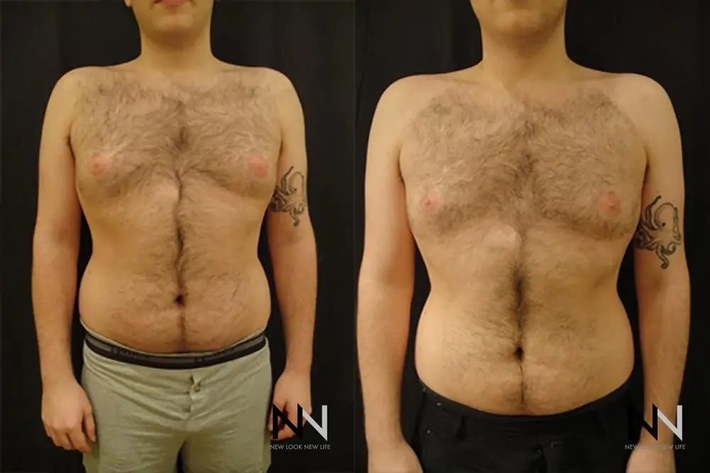 Gynecomastia: Patient 19 - Before and After 1