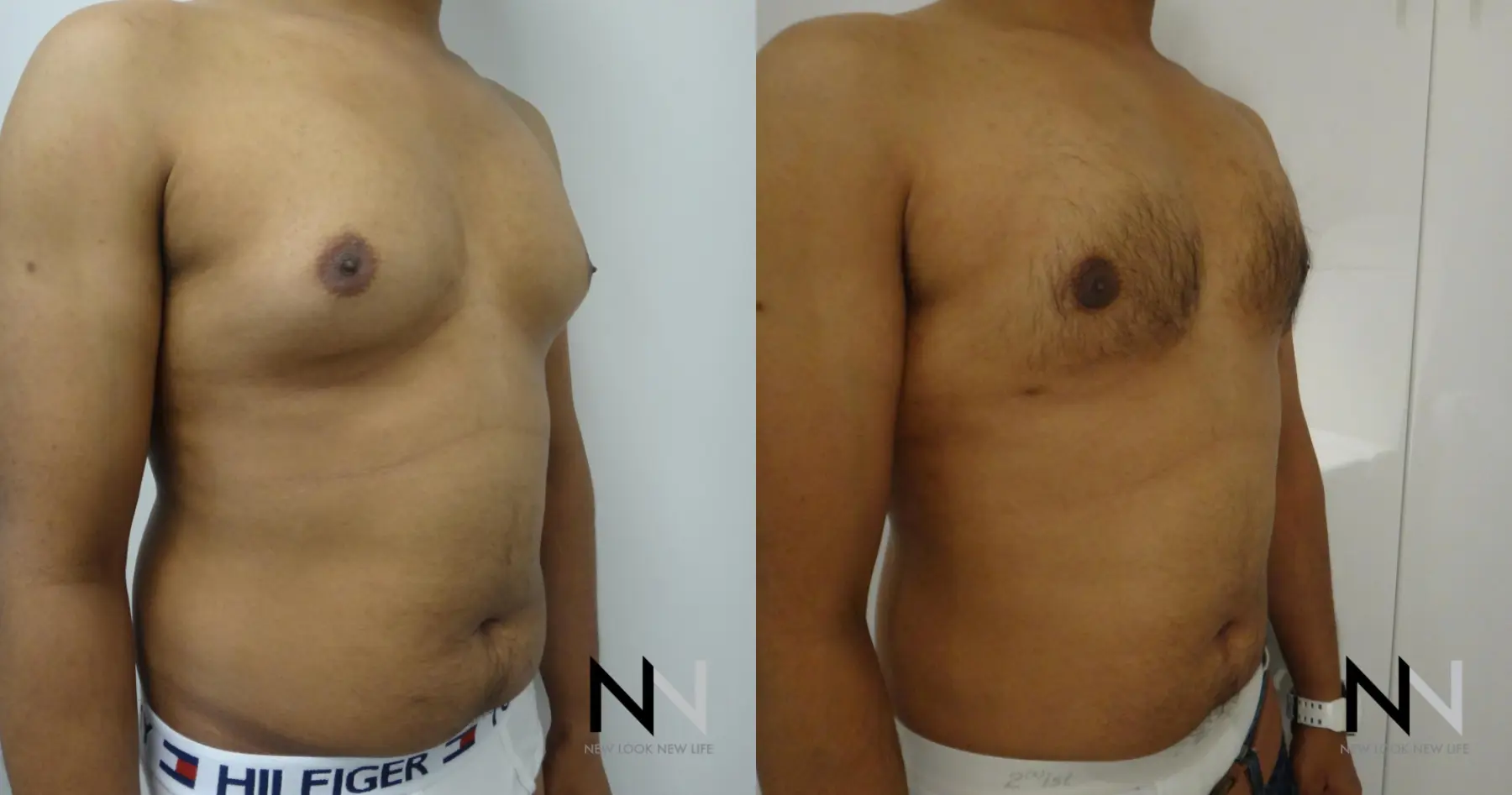 Gynecomastia: Patient 20 - Before and After 3