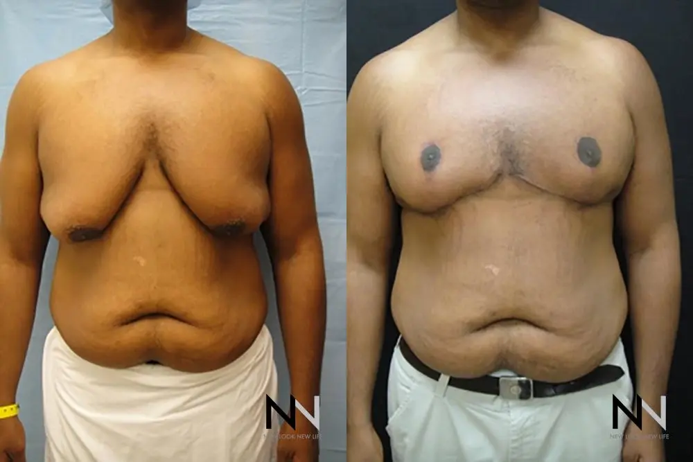 Gynecomastia: Patient 17 - Before and After 1