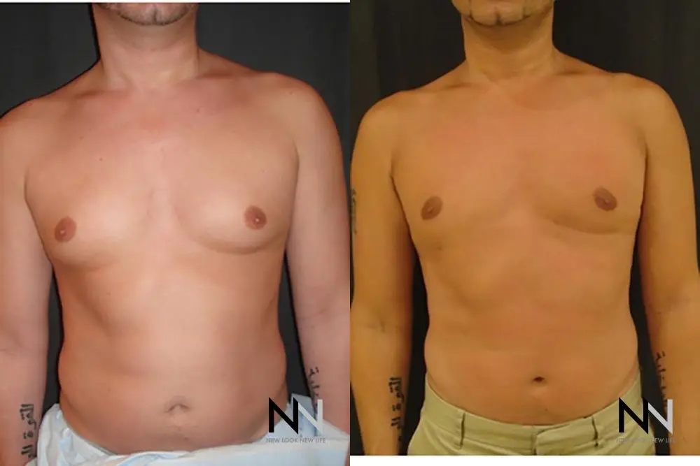 Gynecomastia: Patient 15 - Before and After 1