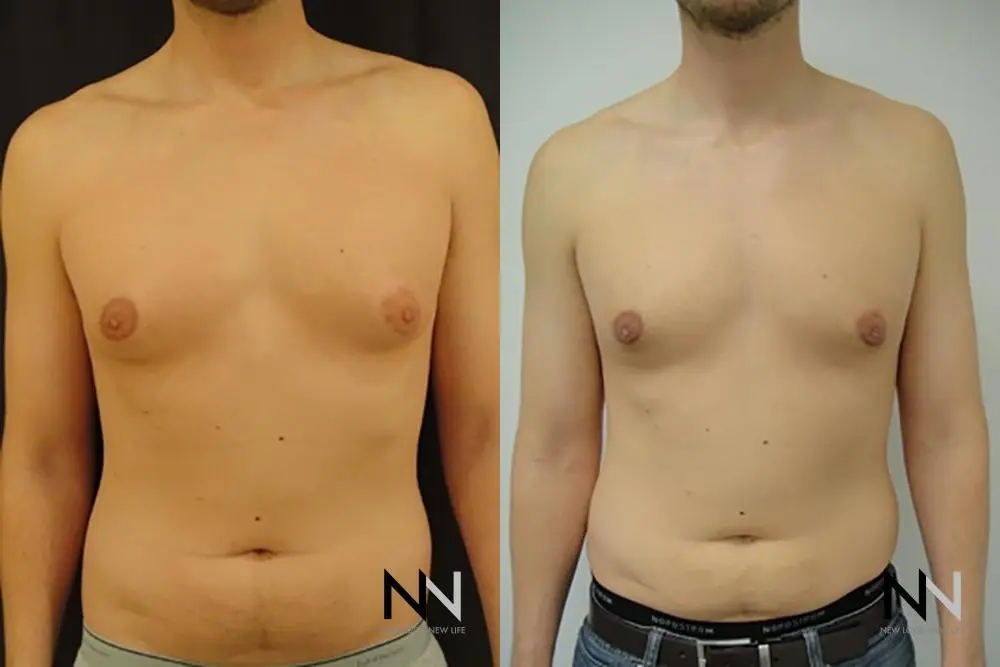 Gynecomastia: Patient 18 - Before and After 1