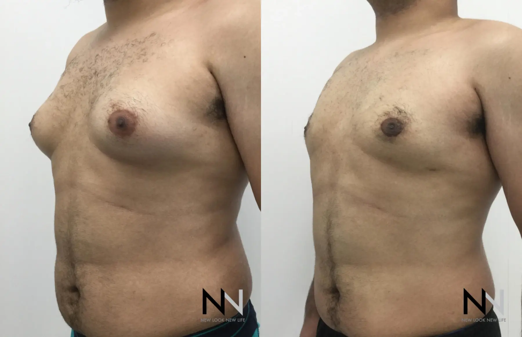 Gynecomastia: Patient 16 - Before and After 5