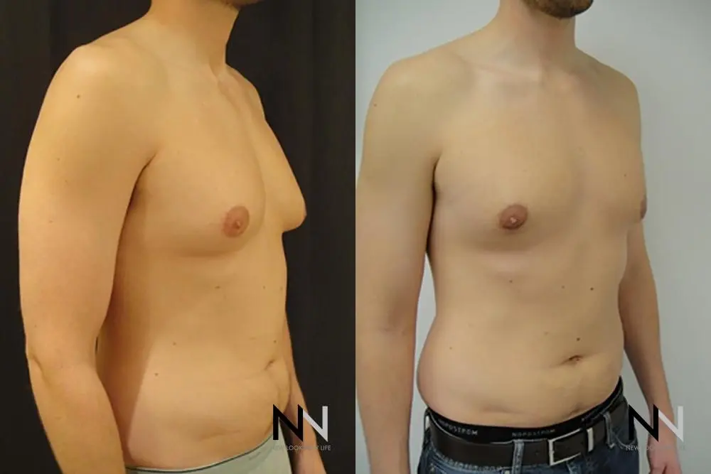 Gynecomastia: Patient 18 - Before and After 3