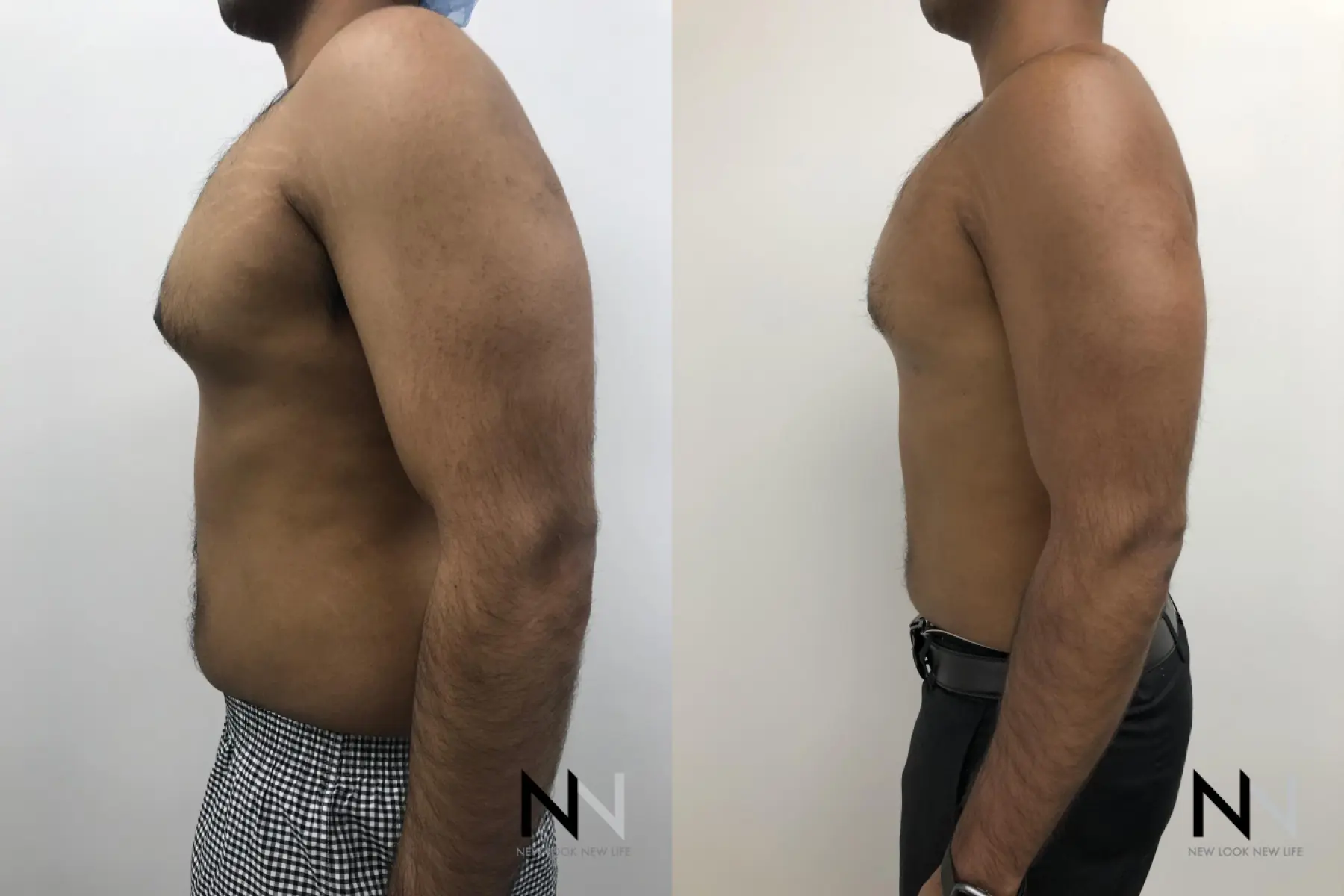 Gynecomastia: Patient 7 - Before and After 2