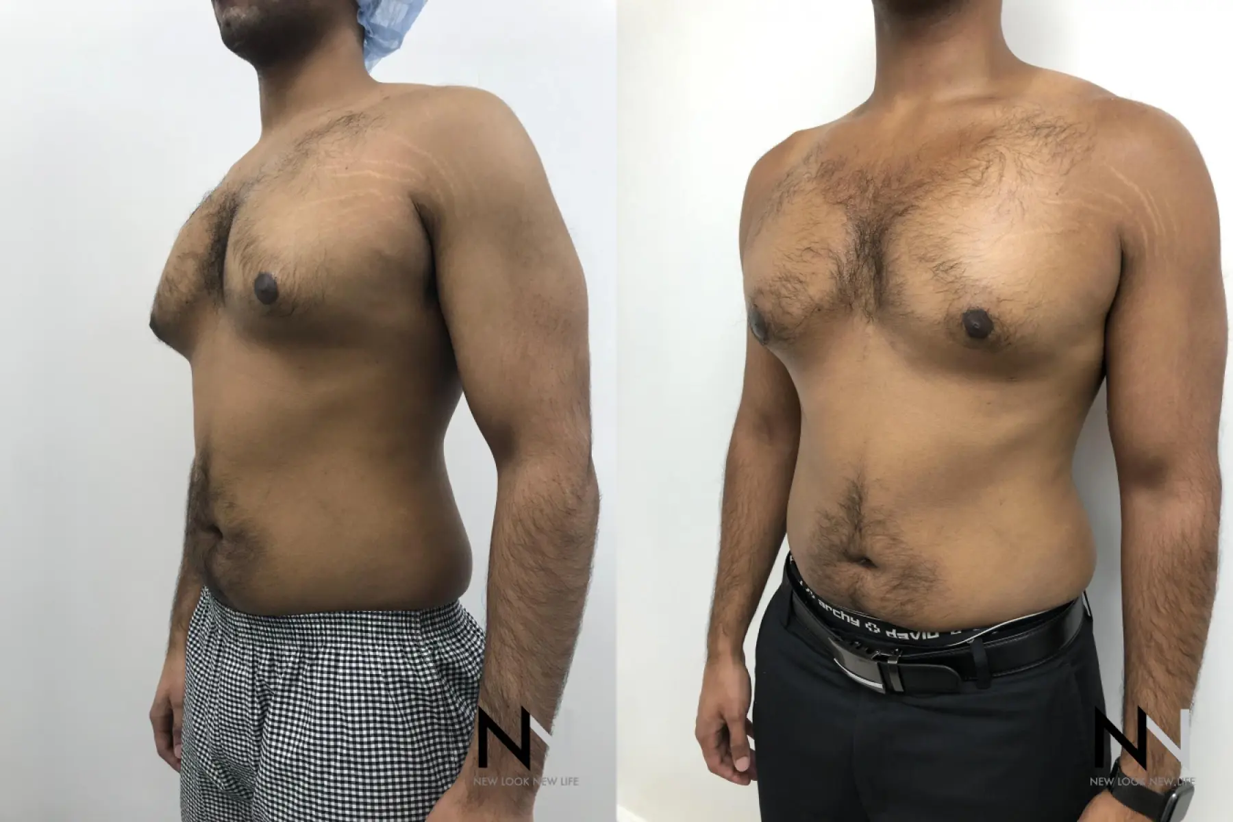 Gynecomastia: Patient 7 - Before and After 3