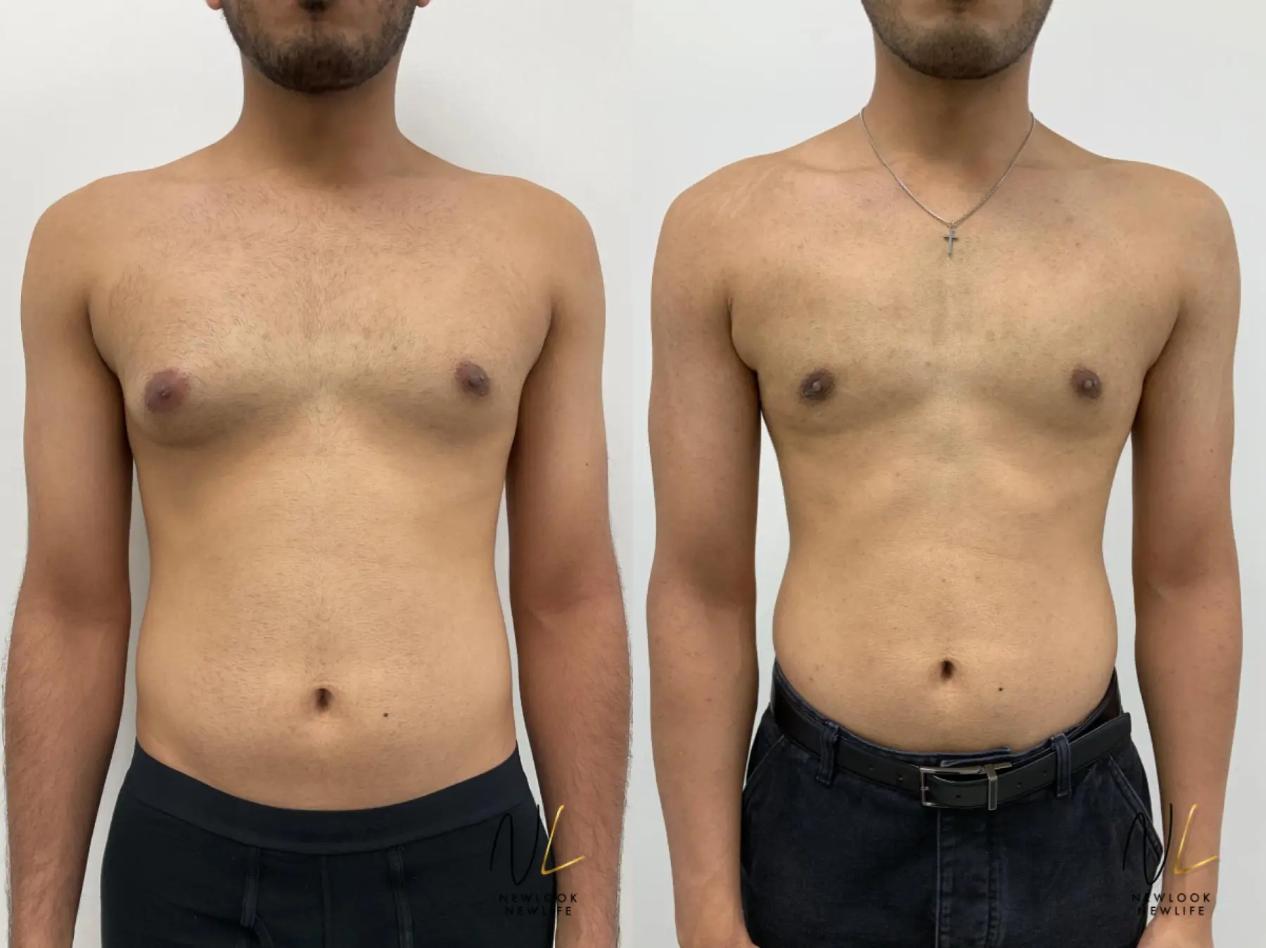 Gynecomastia: Patient 4 - Before and After  