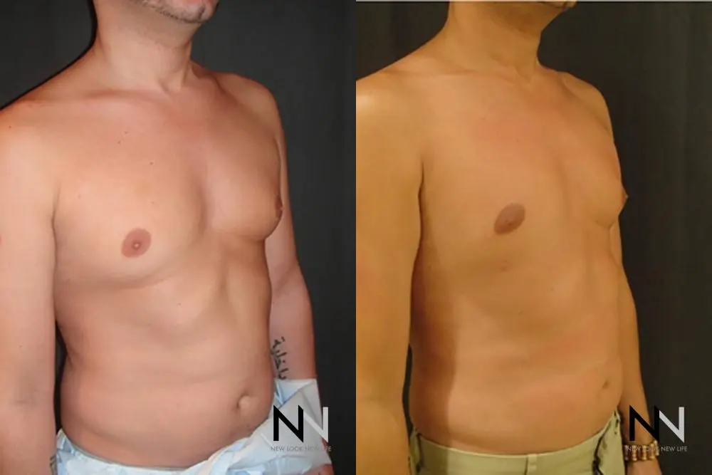 Gynecomastia: Patient 15 - Before and After 3