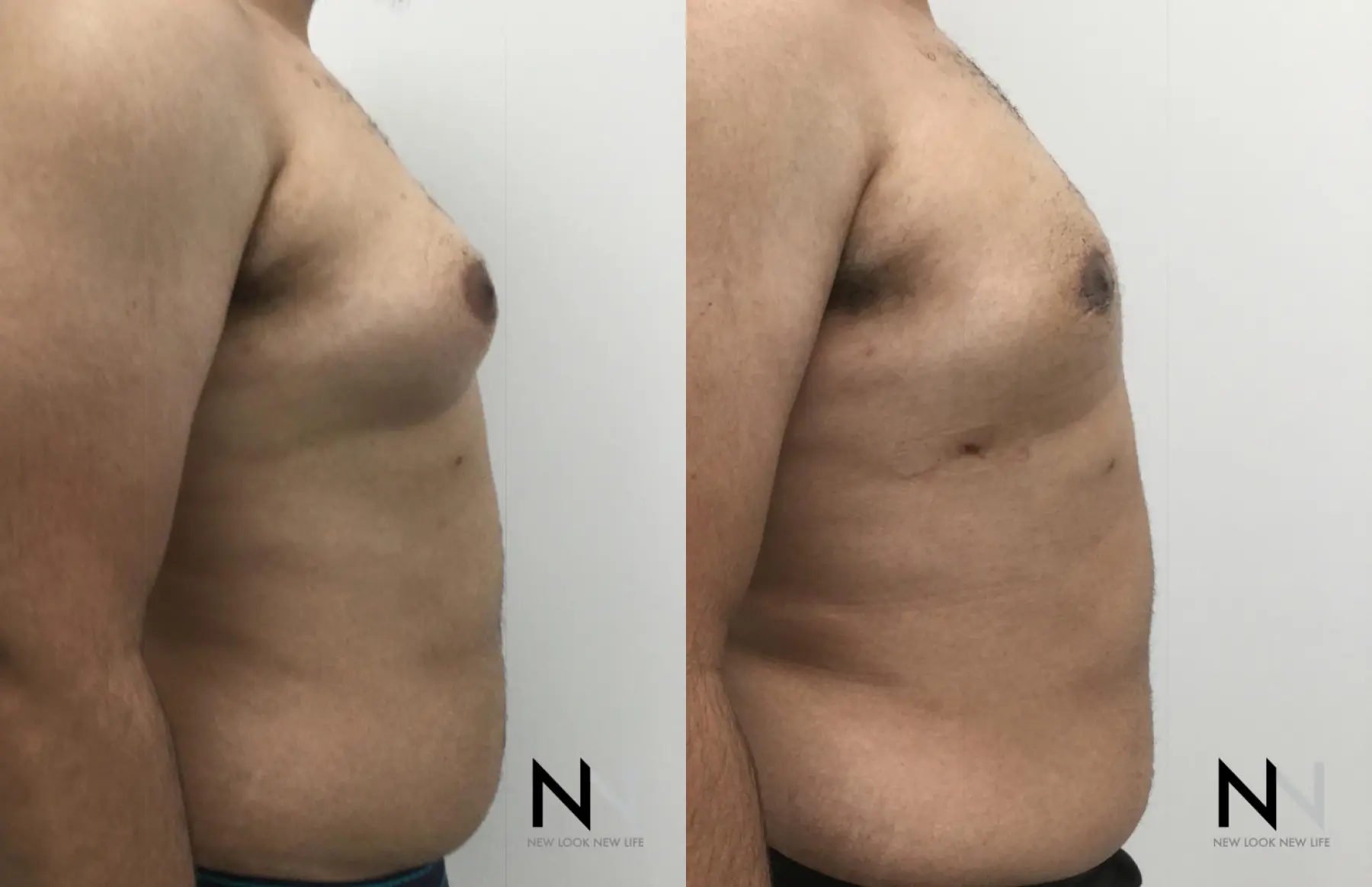 Gynecomastia: Patient 16 - Before and After 3