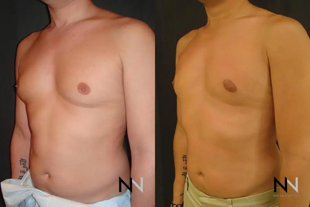 Gynecomastia: Patient 15 - Before and After 2