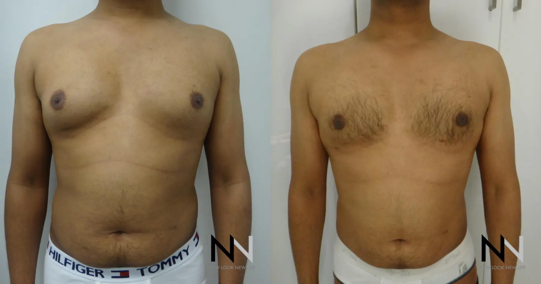 Gynecomastia: Patient 20 - Before and After 1